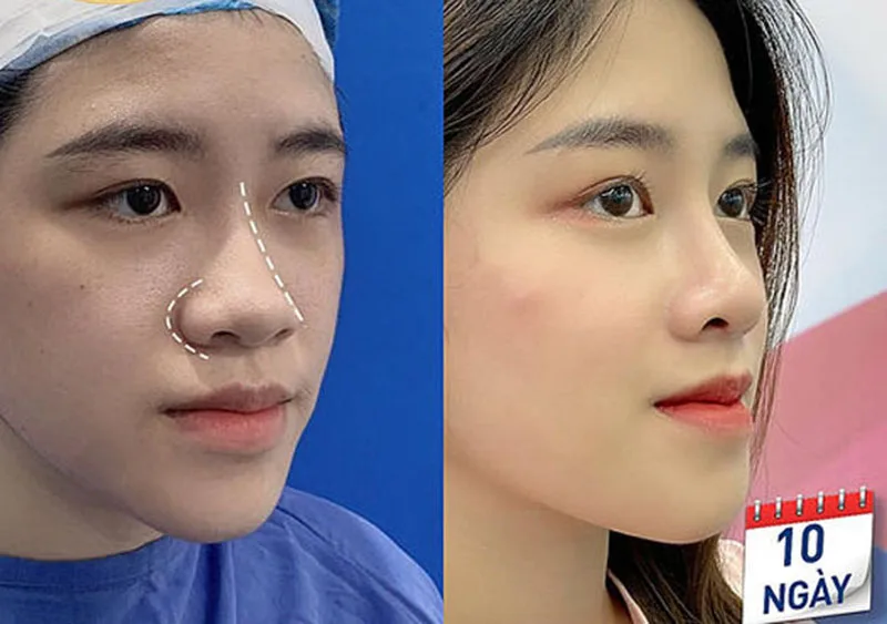 Close-up of alar reduction results after 10 days. 