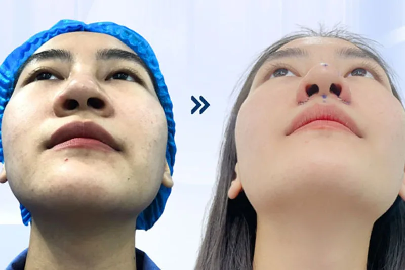 The nostrils will heal 2 to 3 weeks after surgery. 