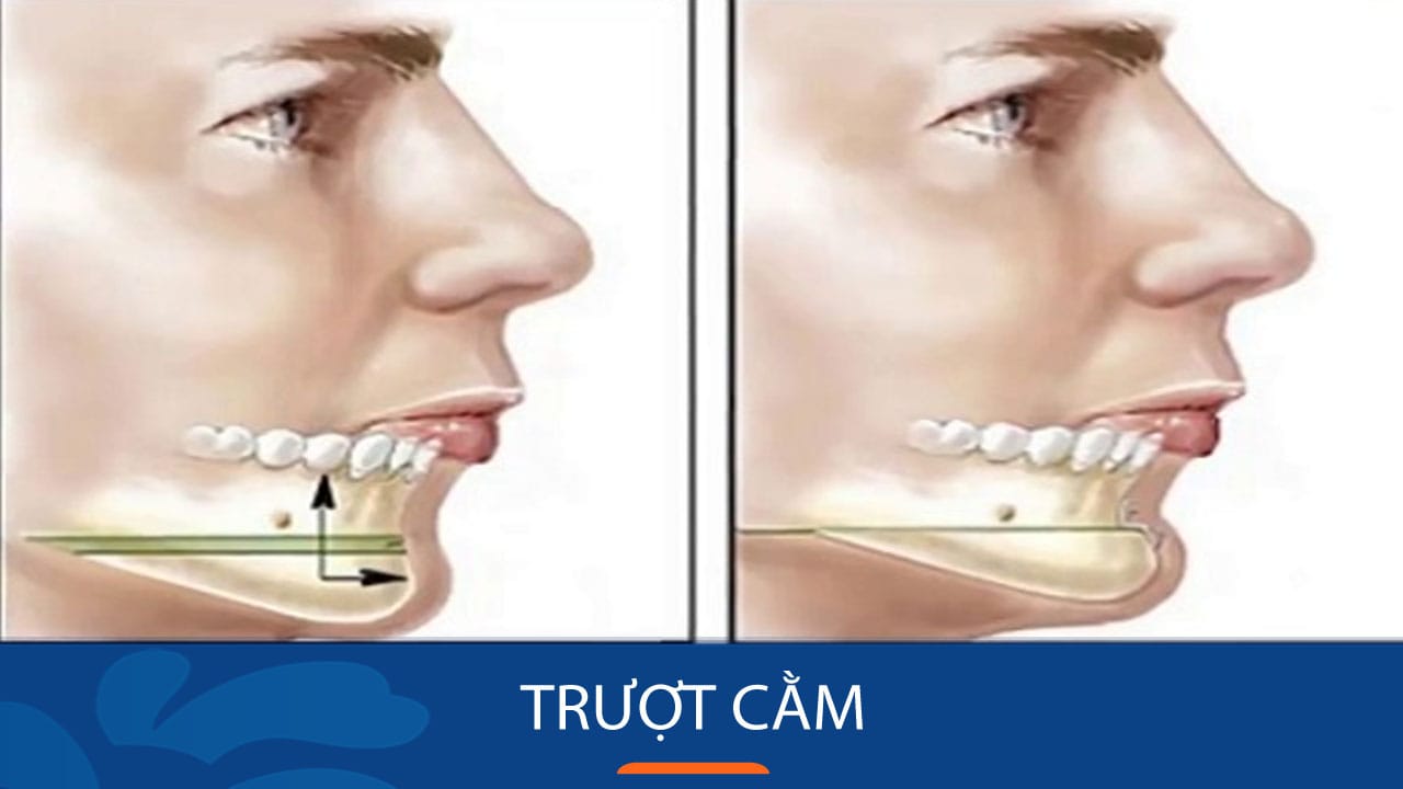Case Trượt cằm xuất sắc của Khách hàng Việt Kiều về nước
