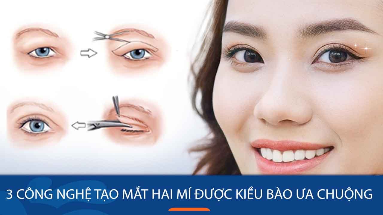 Top 3 công nghệ tạo mắt hai mí được Kiều bào ưa chuộng nhất