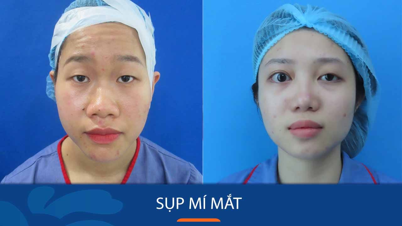 Cách khắc phục sụp mí mắt hiệu quả, không đau chỉ sau 45 phút