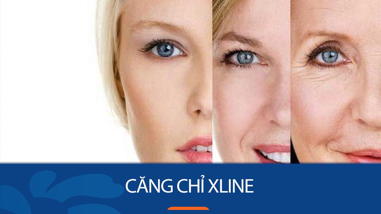 Căng chỉ Xline – Công nghệ dẫn đầu xu hướng trẻ hóa thế hệ mới