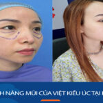 Hành trình nâng mũi không đau của Việt kiều Úc tại Kangnam