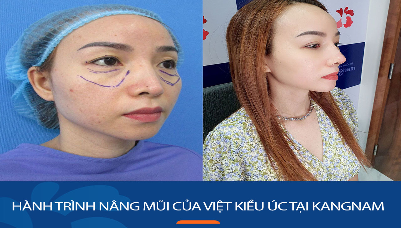 Hành trình nâng mũi không đau của Việt kiều Úc tại Kangnam