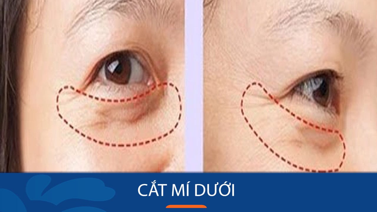 Cắt mí dưới – Trẻ hóa vùng mắt dưới thanh tú, tự nhiên