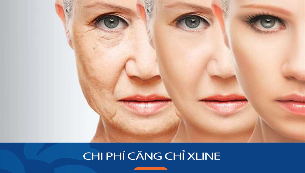 Căng chỉ Xline tại Kangnam bao nhiêu? Bảng giá chi tiết