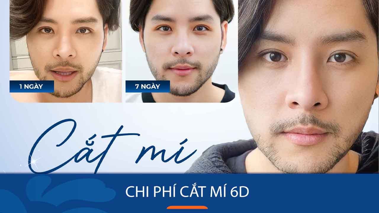 Cắt mí 6D tại Kangnam có đắt không? Bảng giá chi tiết