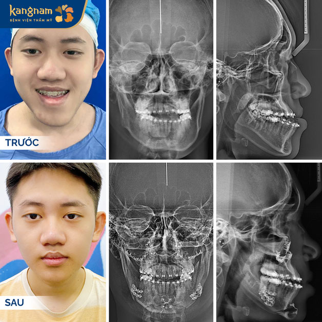 Kangnam - Phẫu thuật mặt lưỡi cày công nghệ 3D hiện đại