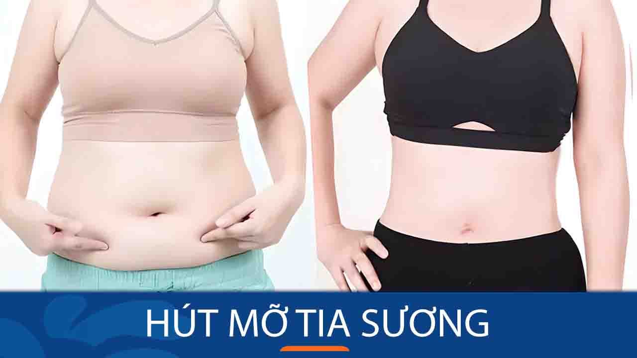 Giảm mỡ Vaser tia sương: Eo thon, dáng chuẩn sau chỉ 1 lần