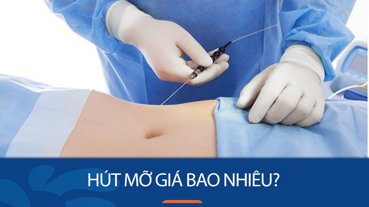Hút mỡ tại Kangnam có đắt không? Bảng giá chi tiết