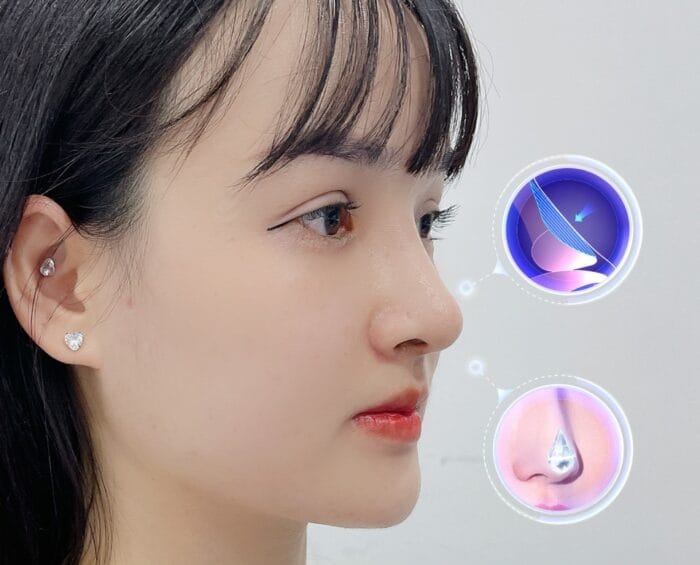 Nâng mũi Hàn Quốc – bí quyết sở hữu dáng mũi đẹp tự nhiên