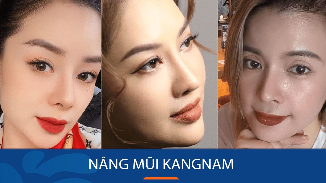 Kangnam – địa chỉ uy tín được Kiều bào lựa chọn để thẩm mỹ mũi
