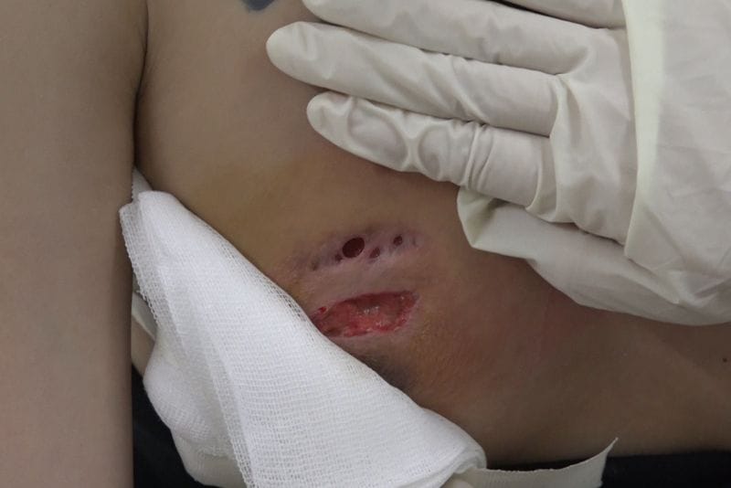 Biến chứng do tiêm filler ngực sai kỹ thuật