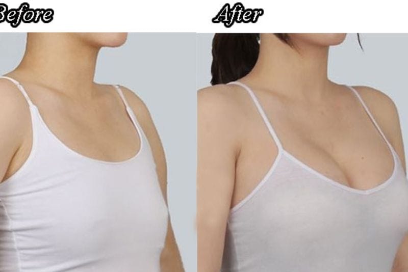 Nâng ngực không phẫu thuật