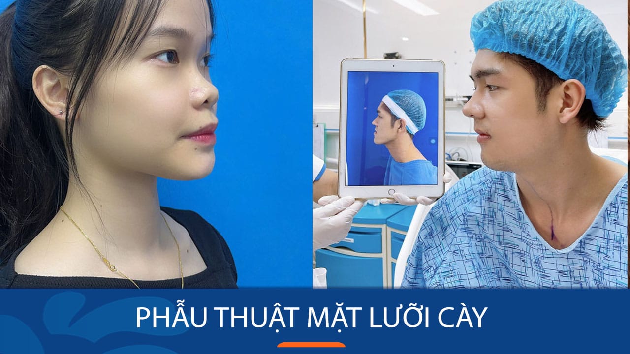 Phẫu thuật mặt lưỡi cày – Tạo hình gương mặt cân đối
