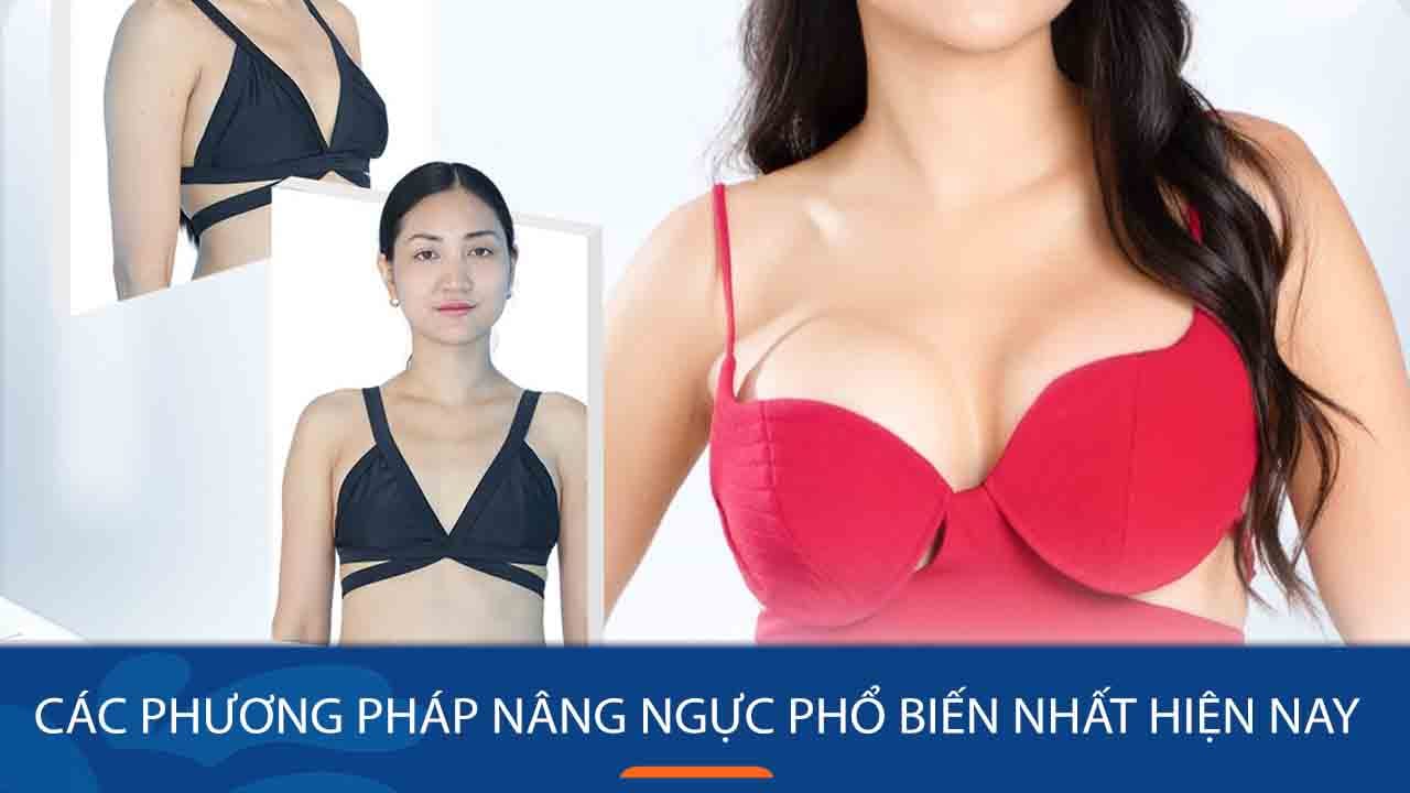 Tổng quan về dịch vụ nâng ngực Kangnam