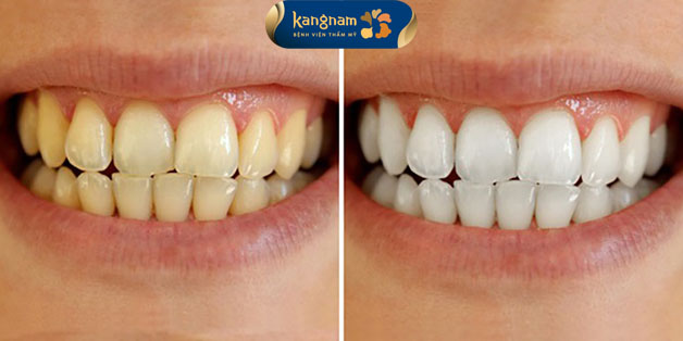 Răng trắng sáng giúp bạn tự tin hơn với nụ cười của mình 