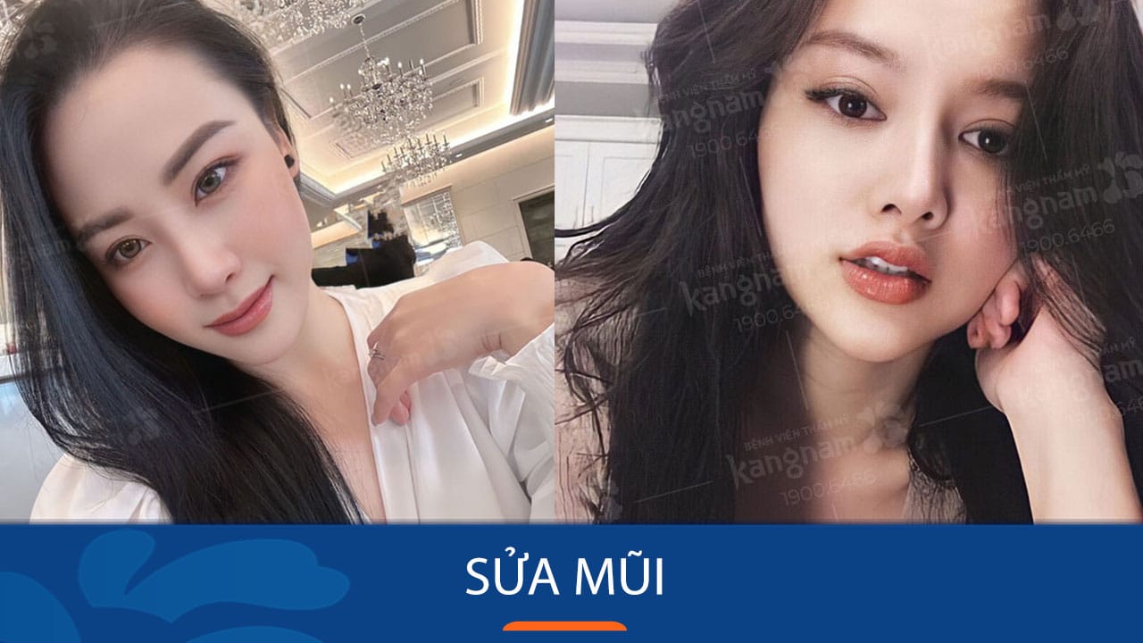 Sửa mũi – Xóa bỏ khuyết điểm mũi, tạo dáng mũi phong thủy