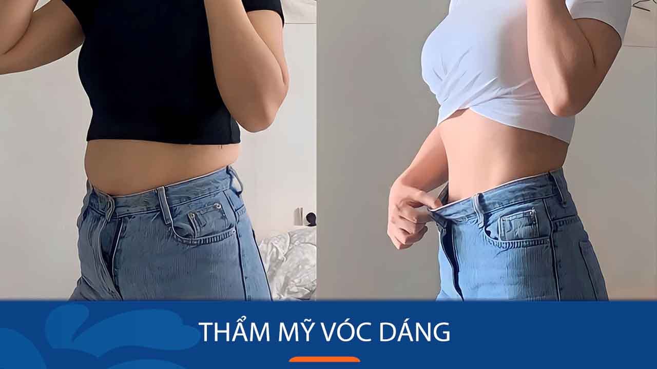 Giải pháp thẩm mỹ vóc dáng – Lấy lại vẻ đẹp hình thể cuốn hút vạn người mê