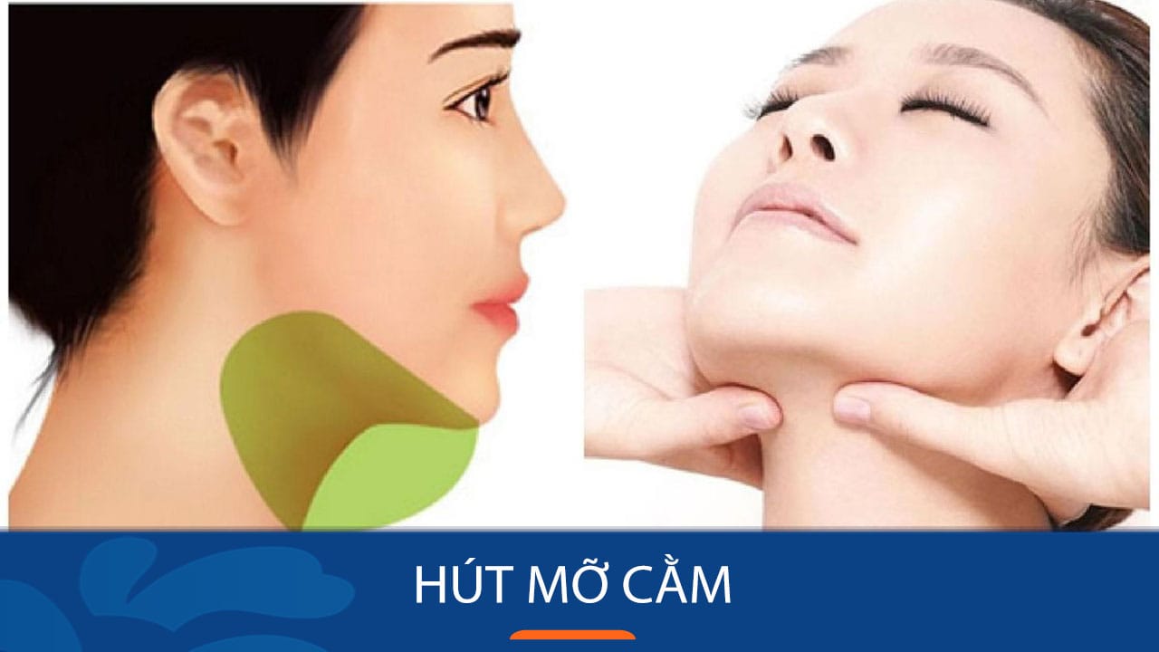 Hút mỡ cằm – Bí quyết sở hữu cằm Vline thon gọn và an toàn