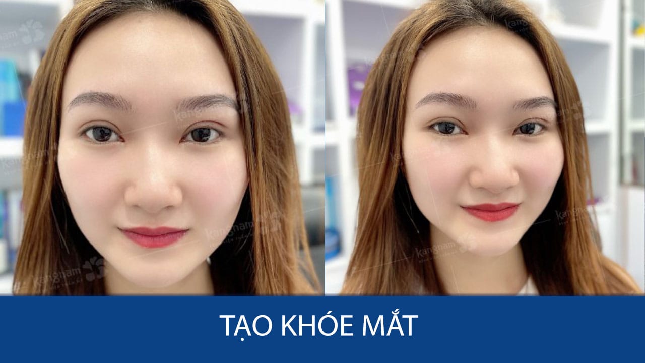 Tạo khóe mắt – sở hữu đôi mắt to tròn, long lanh tại Kangnam