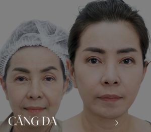 Facelift