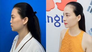 Revision Rhinoplasty in Vietnam: Restoring a Damaged Nose at Kangnam