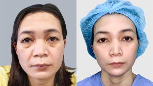Facelift by Dr. Richard Huy – Rejuvenate Your Skin, Hold on to “Youth”