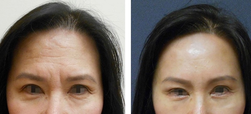 Choose a reputable and quality cosmetic surgeon to ensure safety during surgery.
