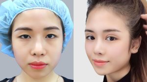 Cosmetic Eye Surgery in Vietnam – Trusted Double Eyelid Procedures for International Patients