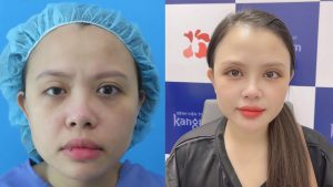Corrective Eyelid Surgery – Causes and Effective Solutions