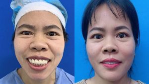 Jaw Surgery in Vietnam – Facial Contouring & Jaw Correction for International Patients