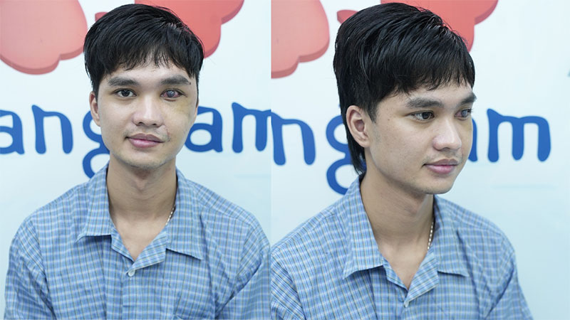 After undergoing surgery by Dr. Richard Huy, Toan was finally able to close his eyes.