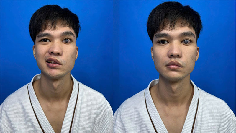 Xuan Toan is a case of facial paralysis causing damage to the left eye.