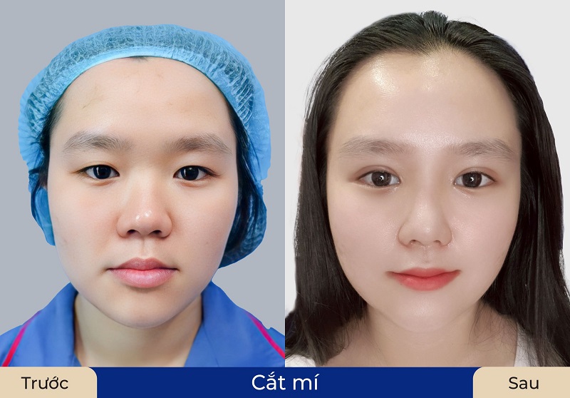 Rejuvenate eyes quickly after eyelid surgery