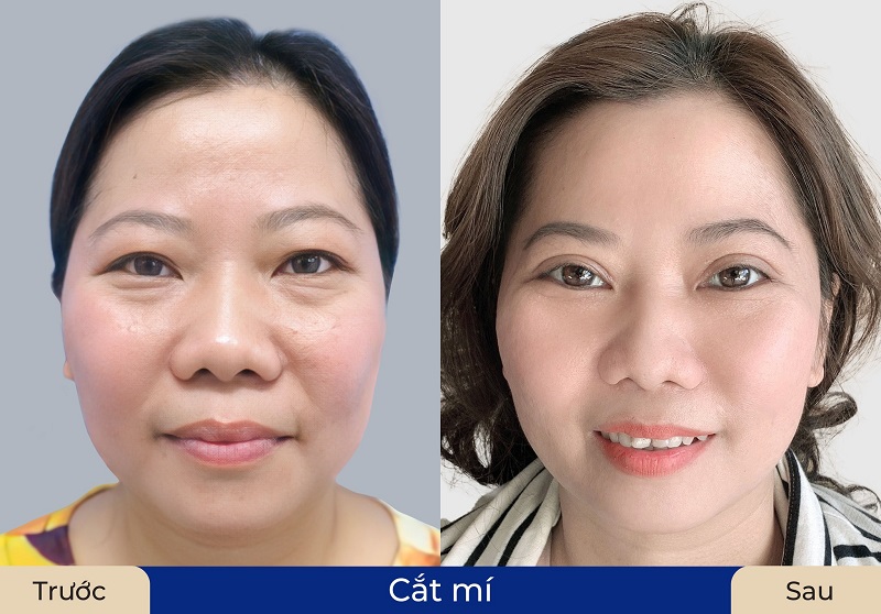 Eyelid folds are balanced and in harmony with the customer's face