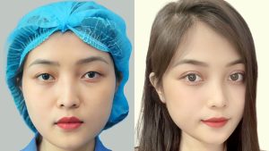 Rapid eye rejuvenation with Kangnam Aesthetic Hospital