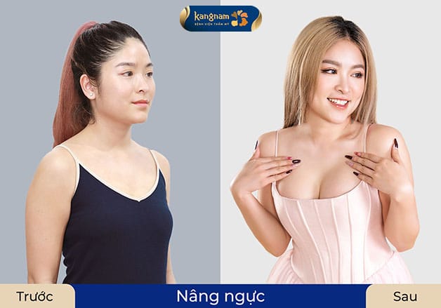 Nâng ngực bền đẹp, vòng một sexy, quyến rũ