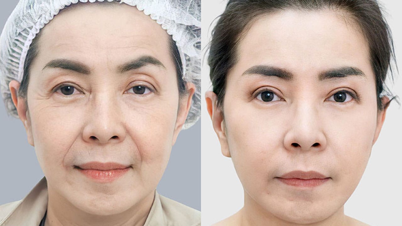 Phẫu thuật căng da mặt – Lựa chọn hàng đầu của Việt Kiều về nước