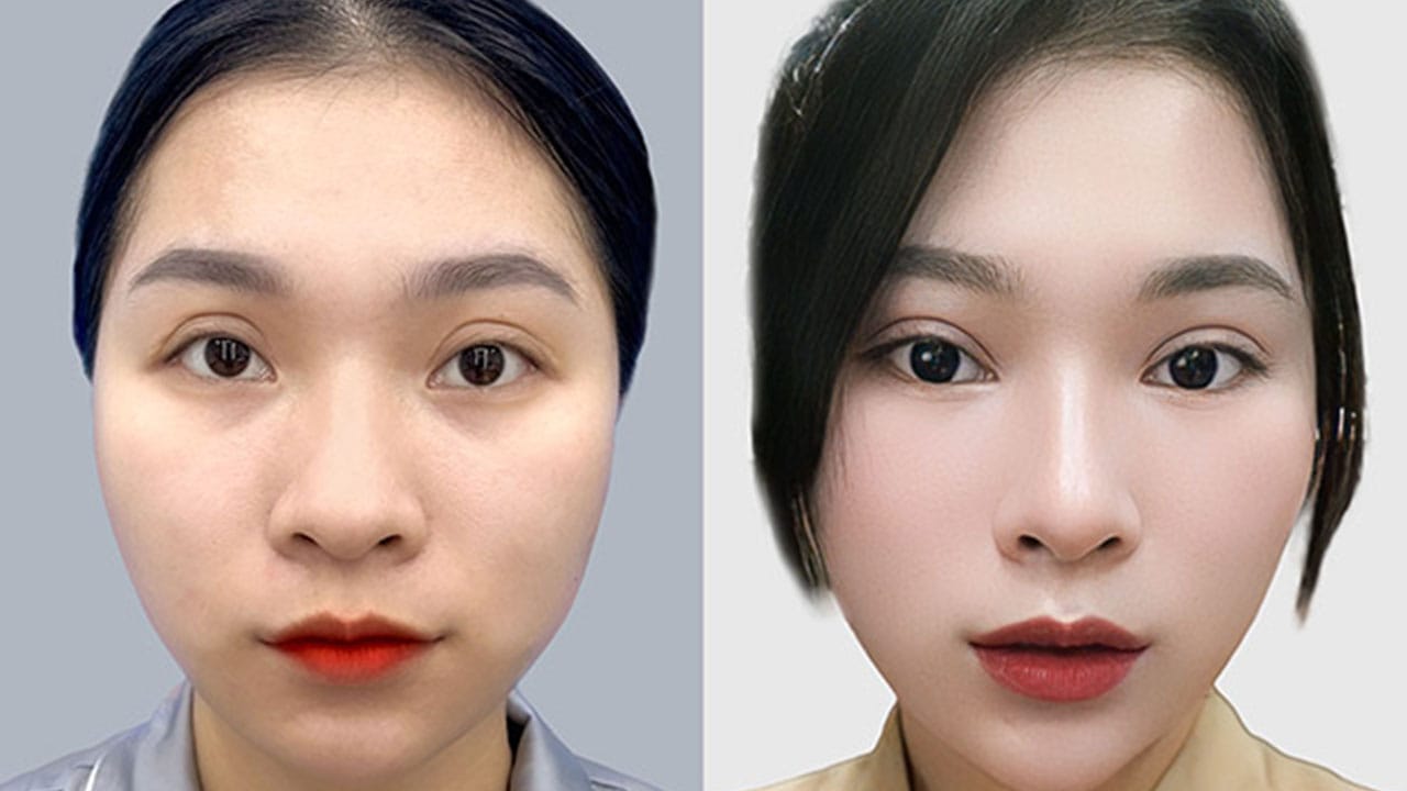 Cắt mí hỏng: Nhận biết và cách khắc phục hiệu quả