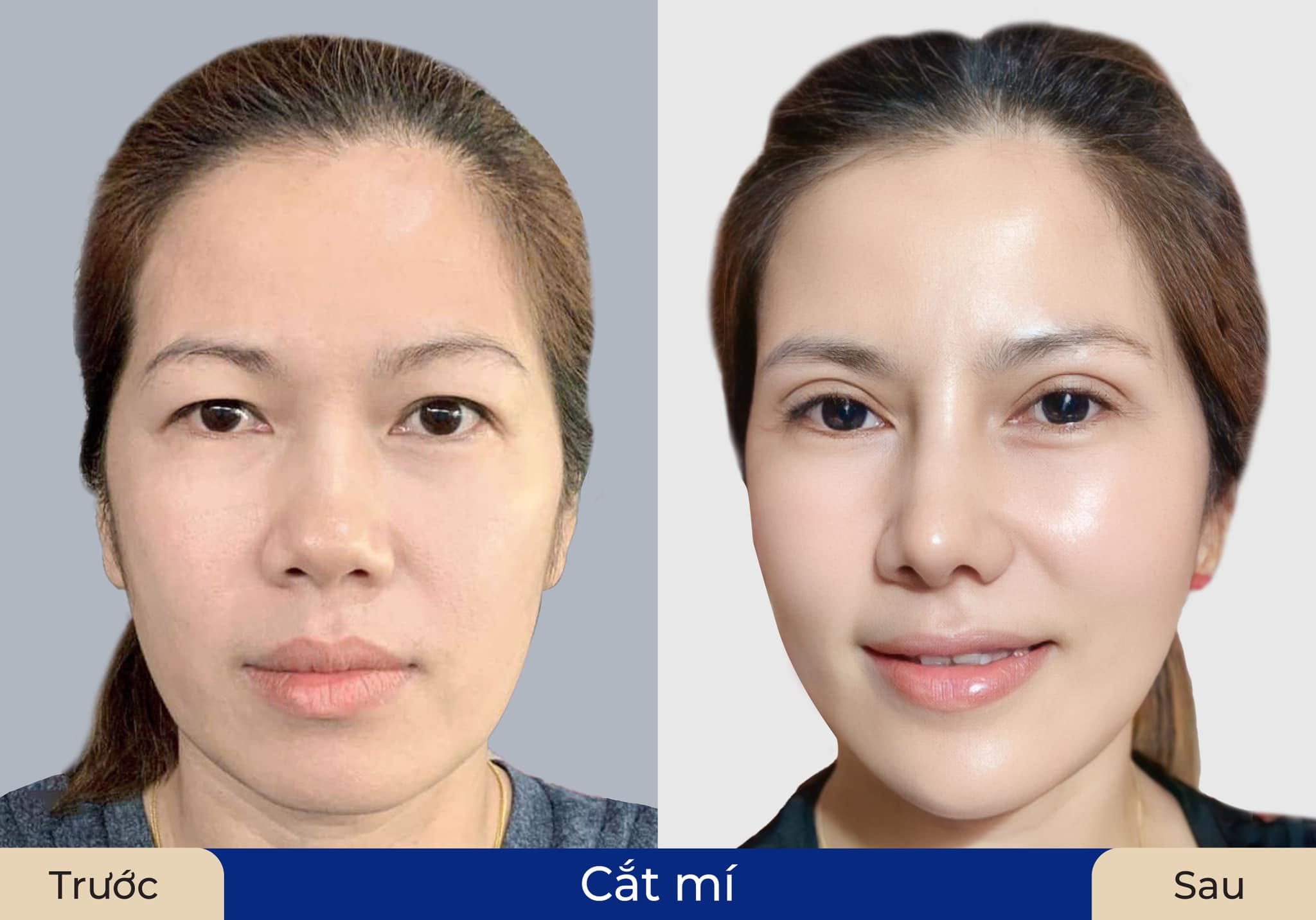 Khách hàng cắt mí Hàn Quốc Plasma hồi phục nhanh, nếp mí ổn định