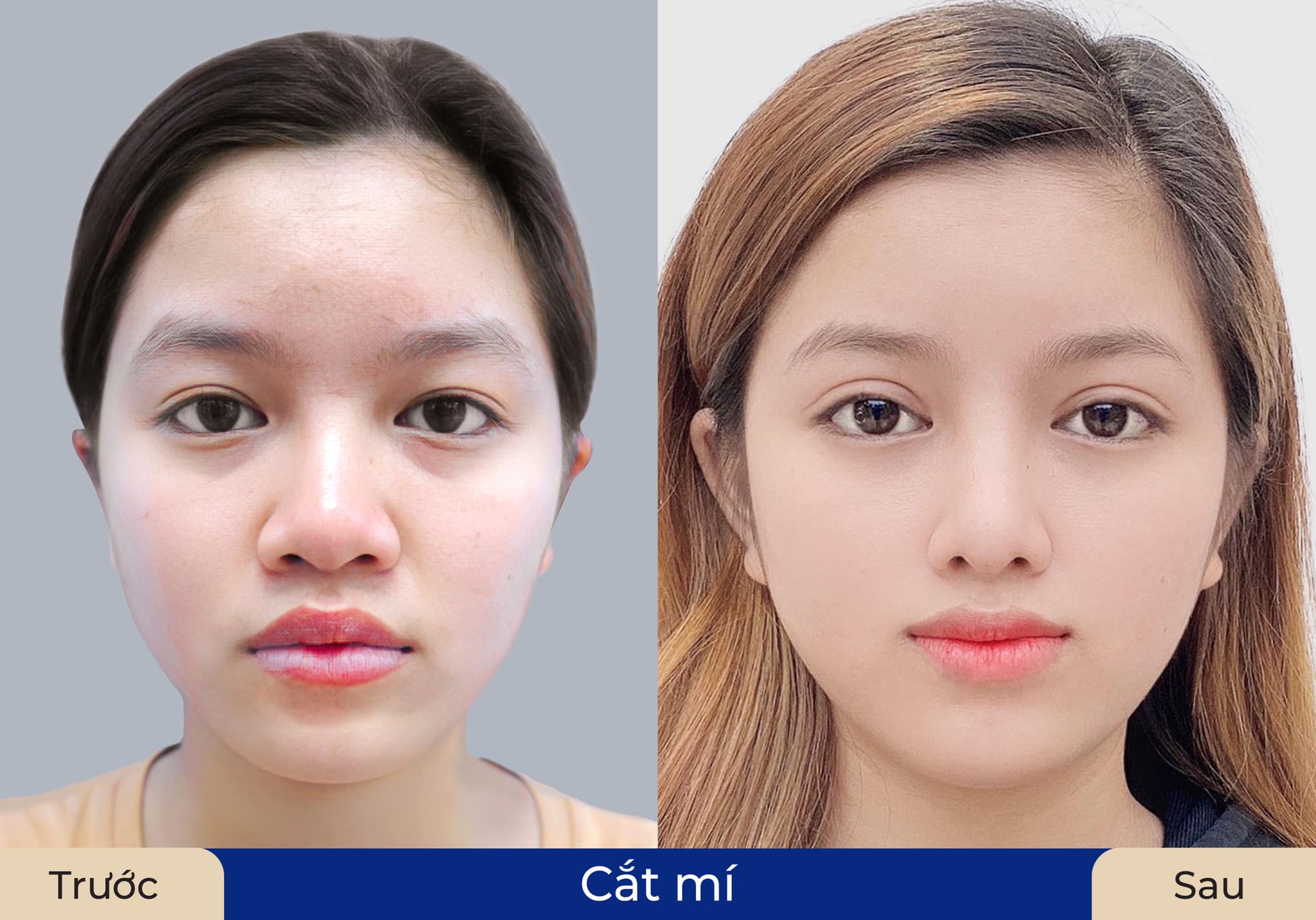 Cắt mí 6D hạn chế sưng nề, đường mí mắt tự nhiên