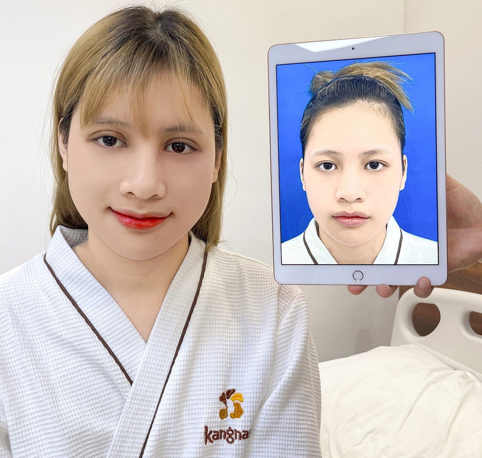 Cắt mí Perfect tạo đường mí cân đối, chống sẹo tối đa cho khách hàng