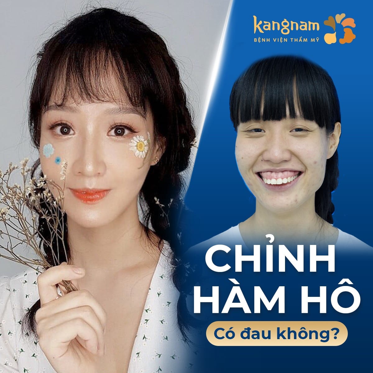 Chỉnh hàm hô không đau, phục hồi nhanh