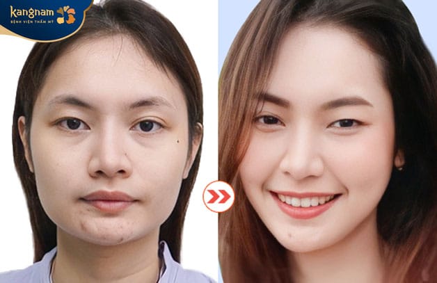 Thăng hạng nhan sắc sau gọt hàm