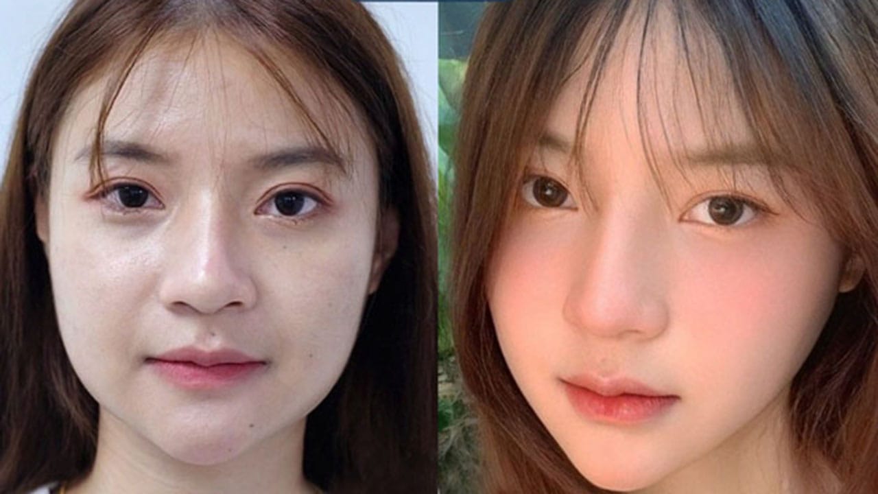 Gọt hàm Vline – Bí quyết giúp khách hàng Việt Kiều sở hữu gương mặt thon gọn 