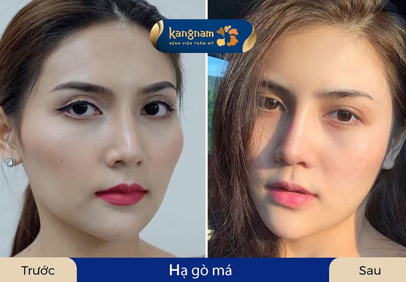 Hạ gò má giúp khách hàng sở hữu gương mặt mềm mại, tươi trẻ