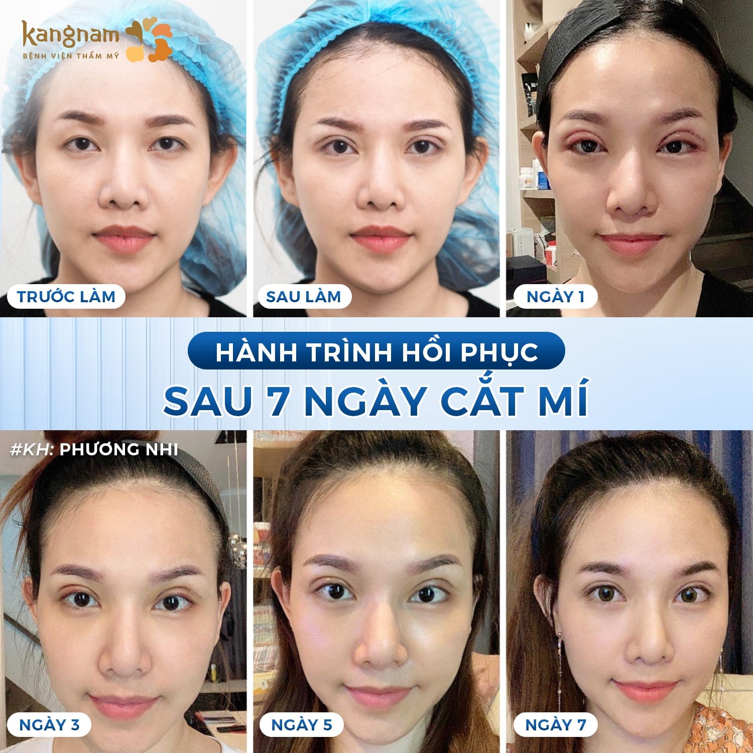 Cắt mí hồi phục nhanh sau 7 ngày, giúp khách hàng Việt Kiều tiết kiệm tối đa thời gian làm đẹp