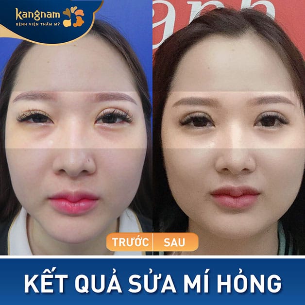 Chỉnh sửa 2 bên mí không đều, tạo nếp mí cân đối và hài hòa