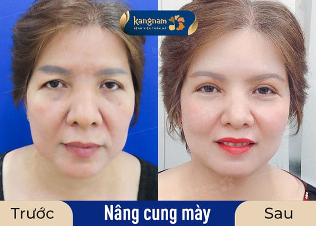 Khách hàng trước và sau khi nâng cung mày, đôi mắt to và sáng hơn